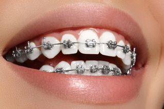 Get braces