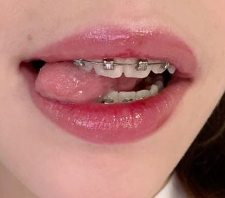 Braces