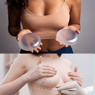 BREAST IMPLANT