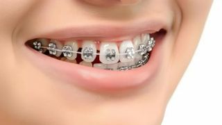 Beautiful smile (braces)