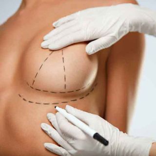 Breast augmentation