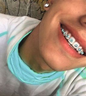 Braces?